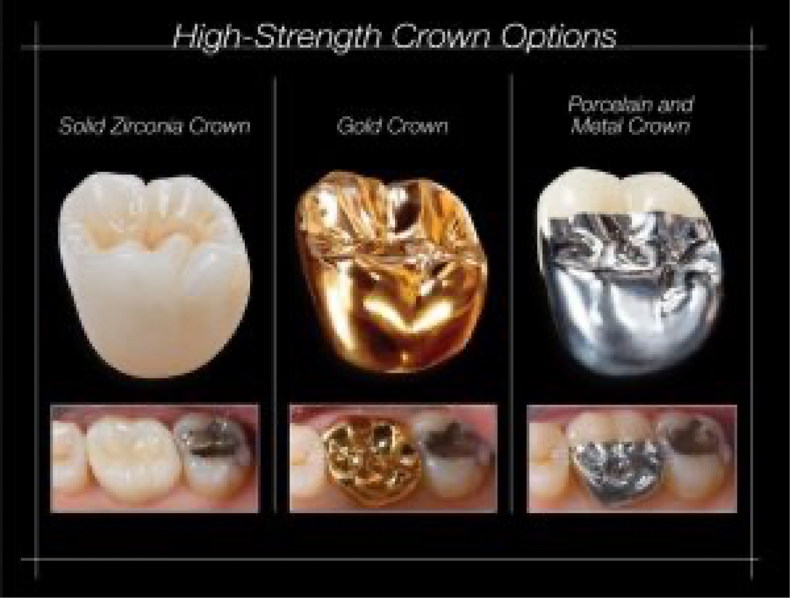 Dental Crowns Bushy Park Dental Practice